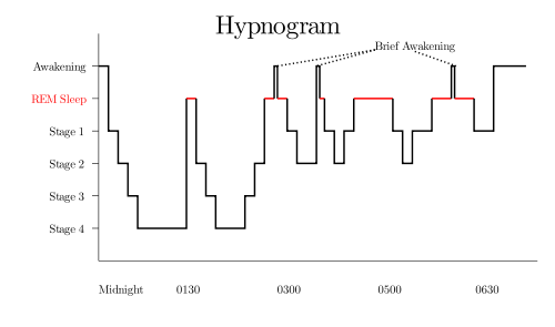 Sleep Hypnogram